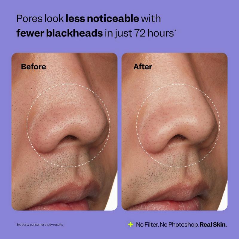 Peach Slices Nose Pore Patches #5