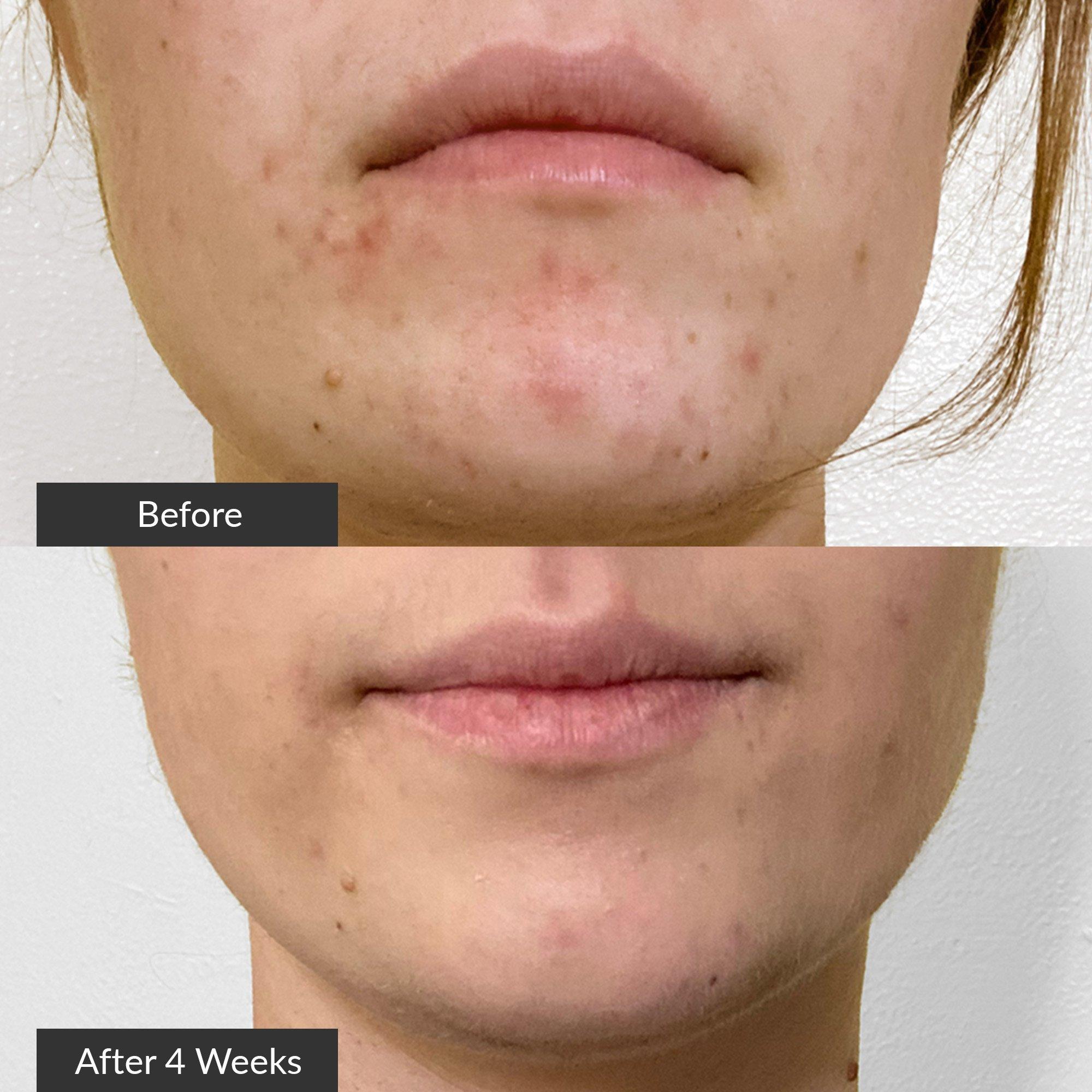 Точечное средство от акне с синим светом PMD Clean Acne — фото 7