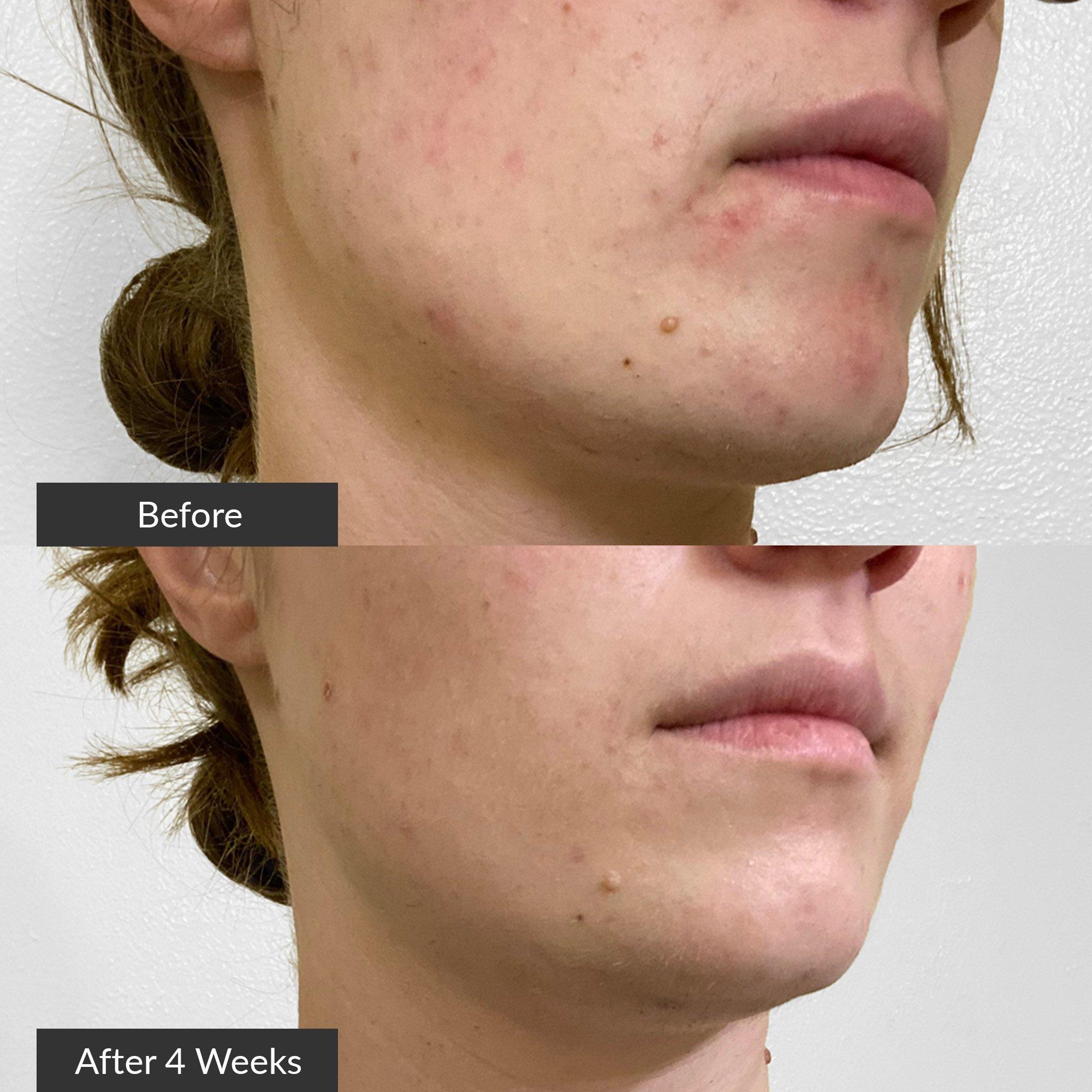 Точечное средство от акне с синим светом PMD Clean Acne — фото 8