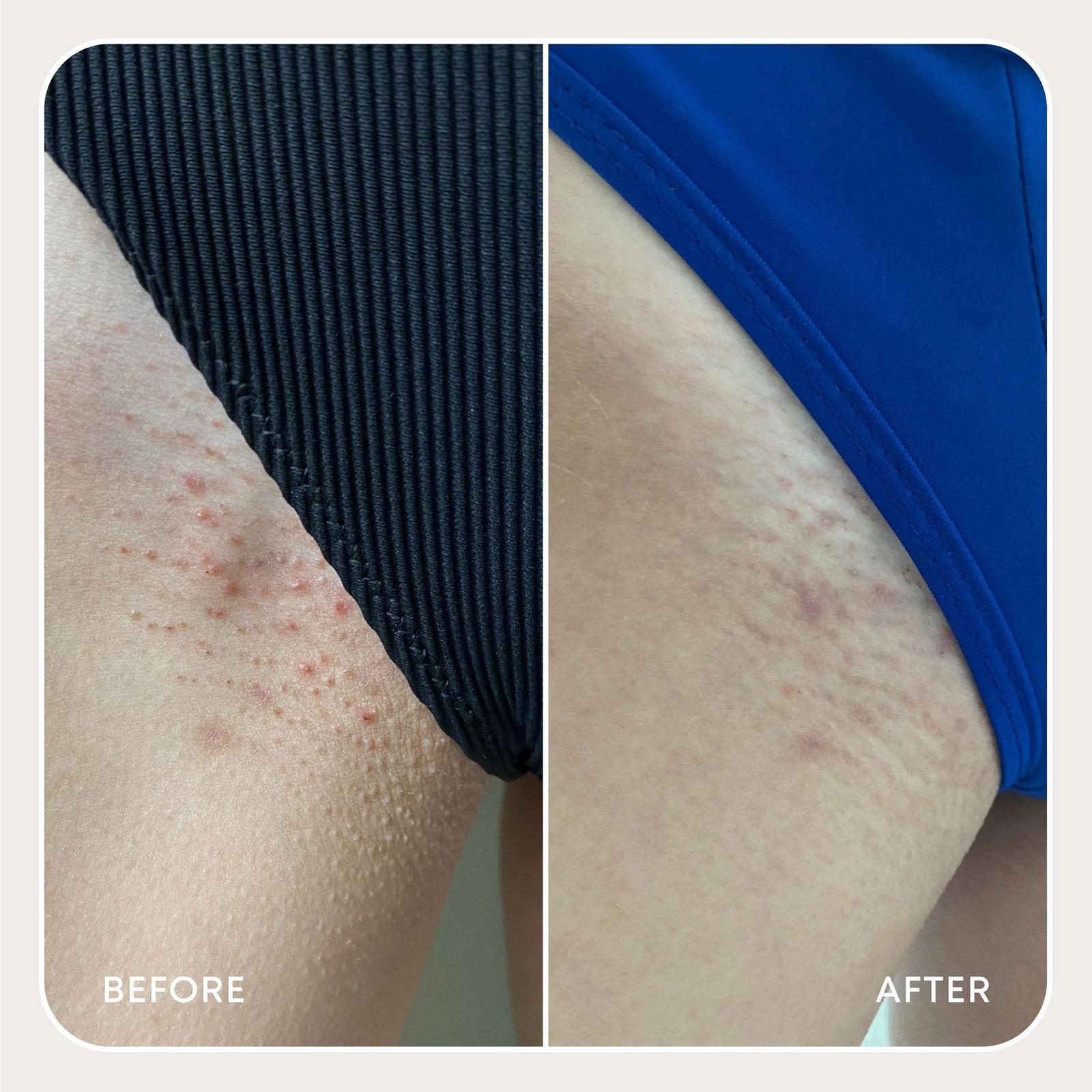 Ingrown Exfoliating Hair Scrub