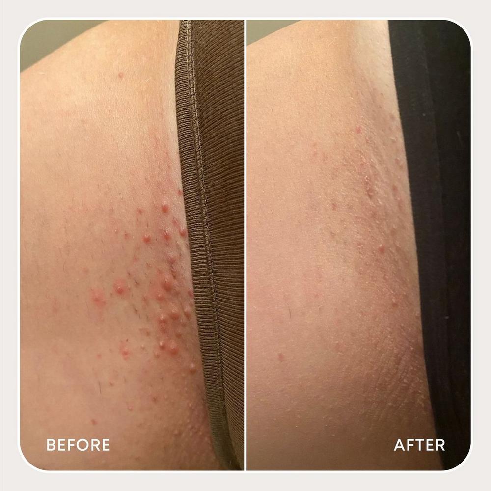 Ingrown Hair Exfoliating Scrub