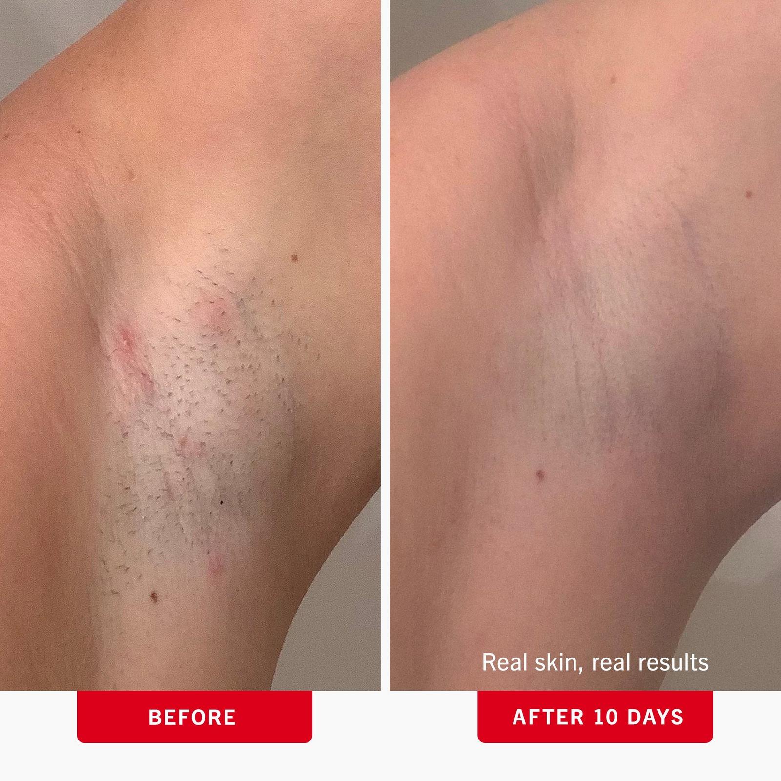 Ingrown Hair Pads with BHA & AHA