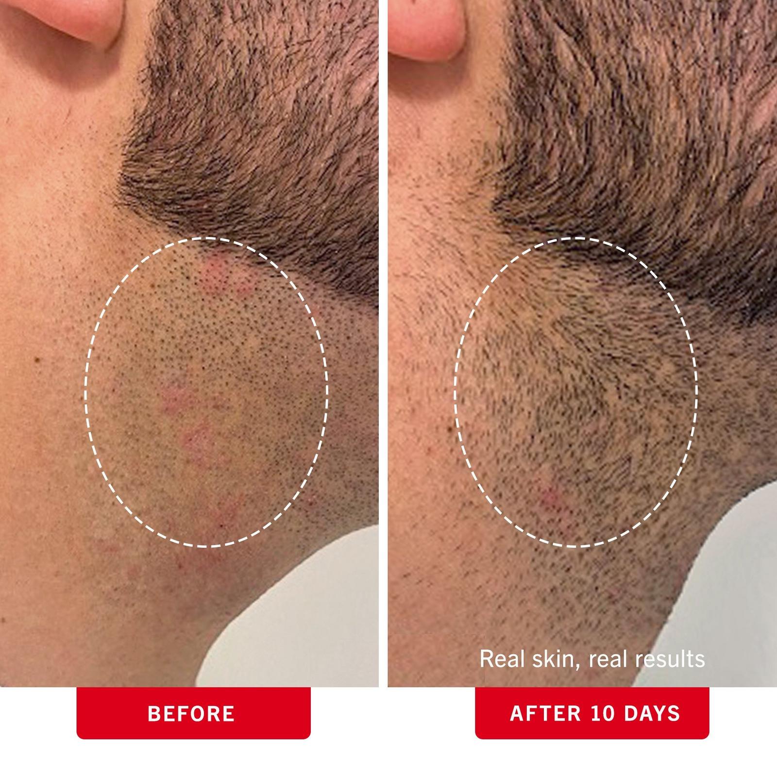 Ingrown Hair Pads with BHA & AHA