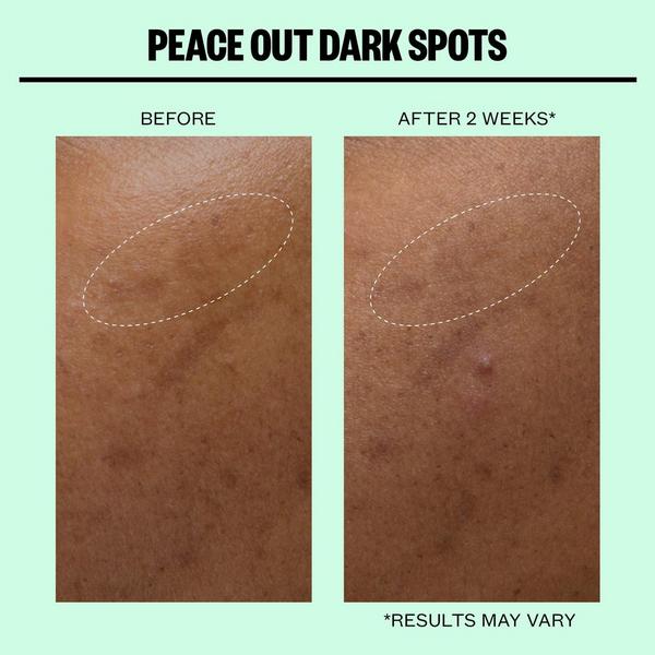 Peace Out Dark Spots Microneedling Brightening Dots #5