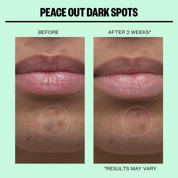 Peace Out Dark Spots Microneedling Brightening Dots #6