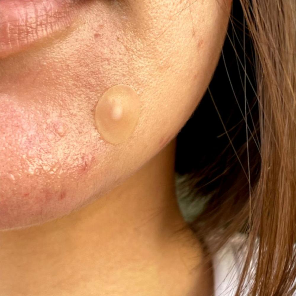 Salicylic Acid Acne Healing Dots - 40 ct