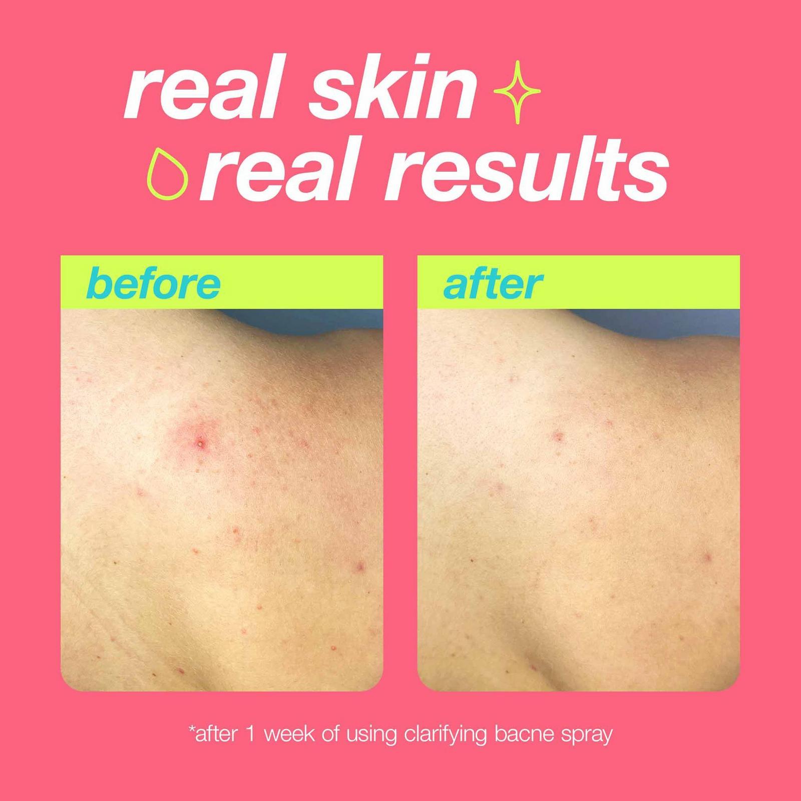 Clear Start Clarifying Bacne Spray
