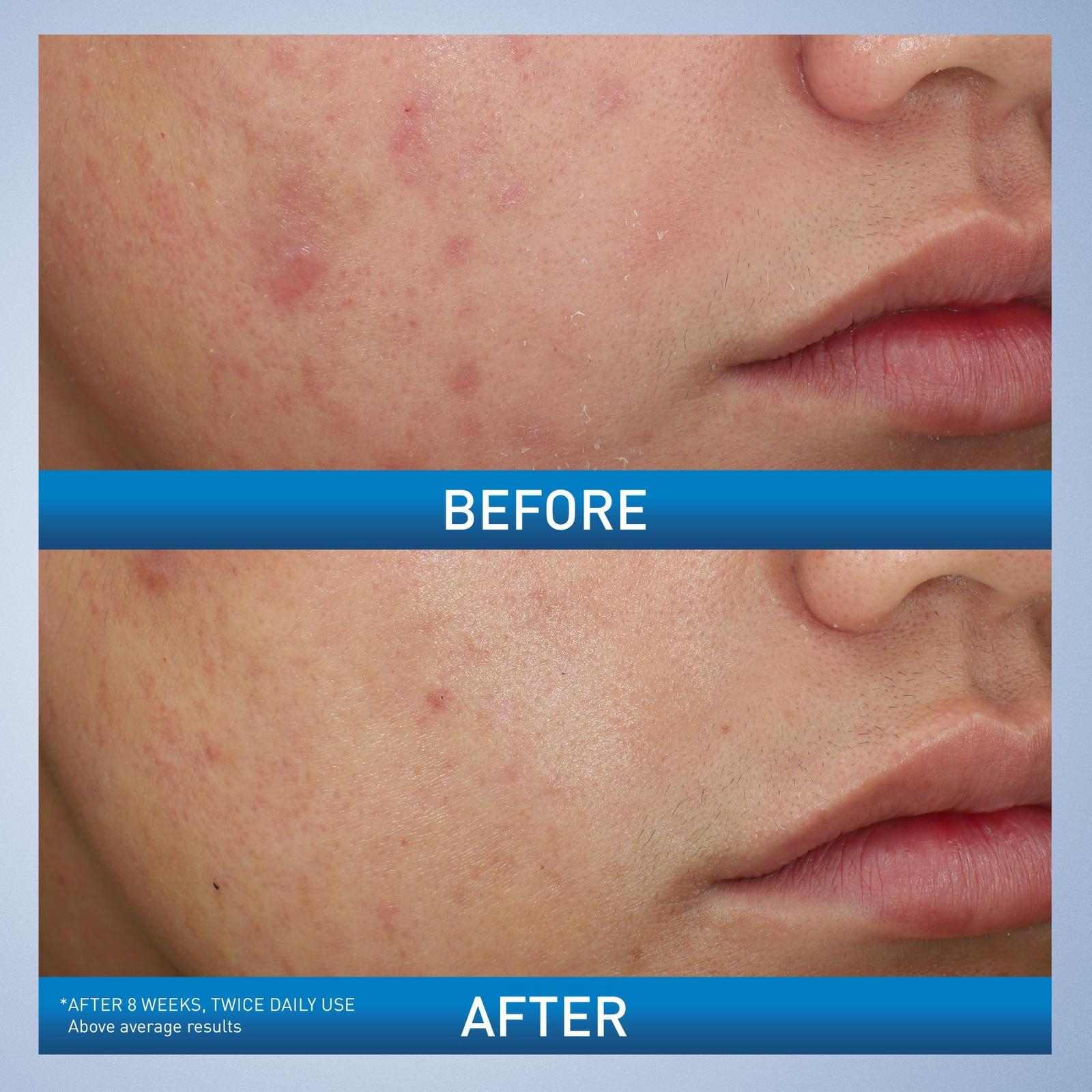 Acne Foaming Cream Wash BPO 10% for Face & Body