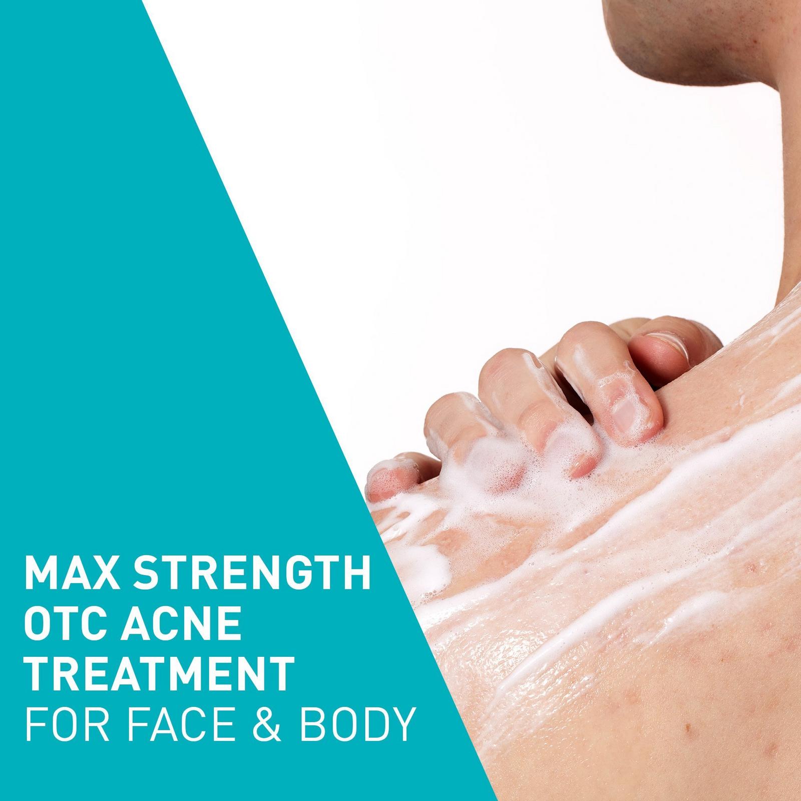 Acne Foaming Cream Wash BPO 10% for Face & Body