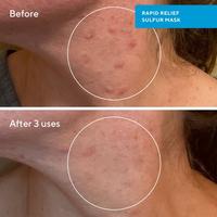 Rapid Relief Acne Sulfur Clay Mask