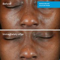 Rapid Relief Acne Sulfur Clay Mask