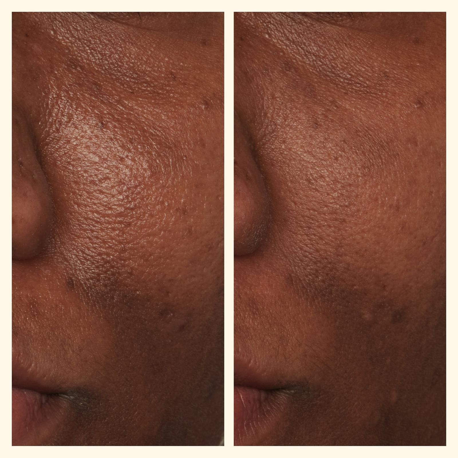 Potato Peel Rapid Resurfacing Milk Facial