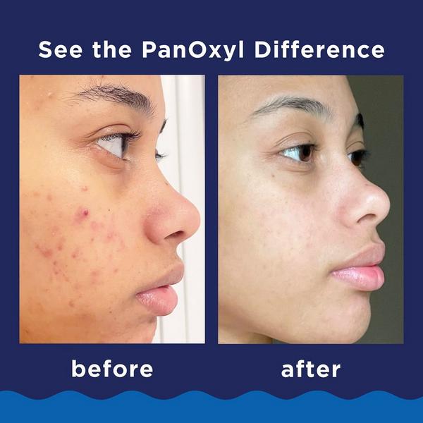 PanOxyl Acne Foaming Wash with 10% Benzoyl Peroxide #5