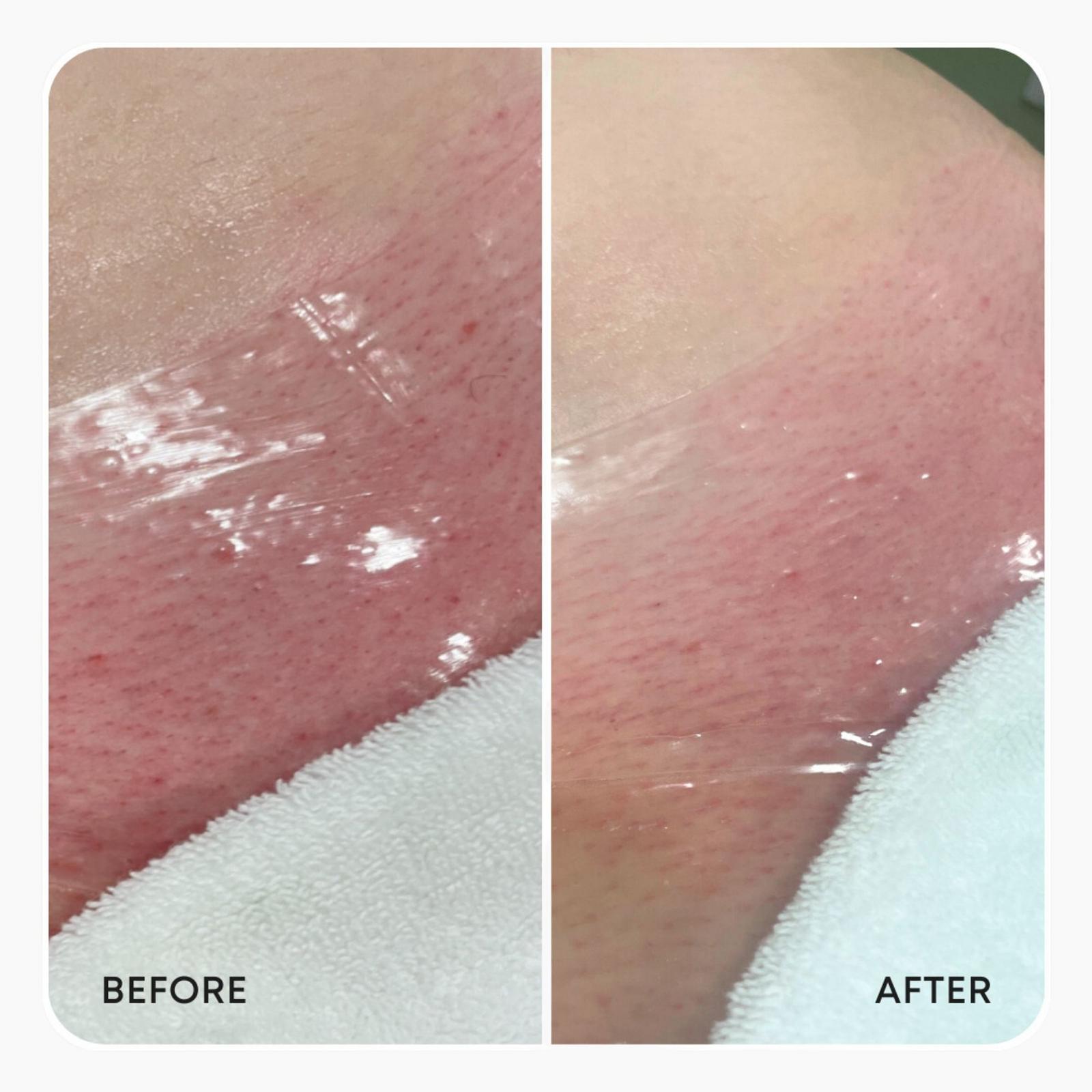 Hydrogel Vajacial Mask