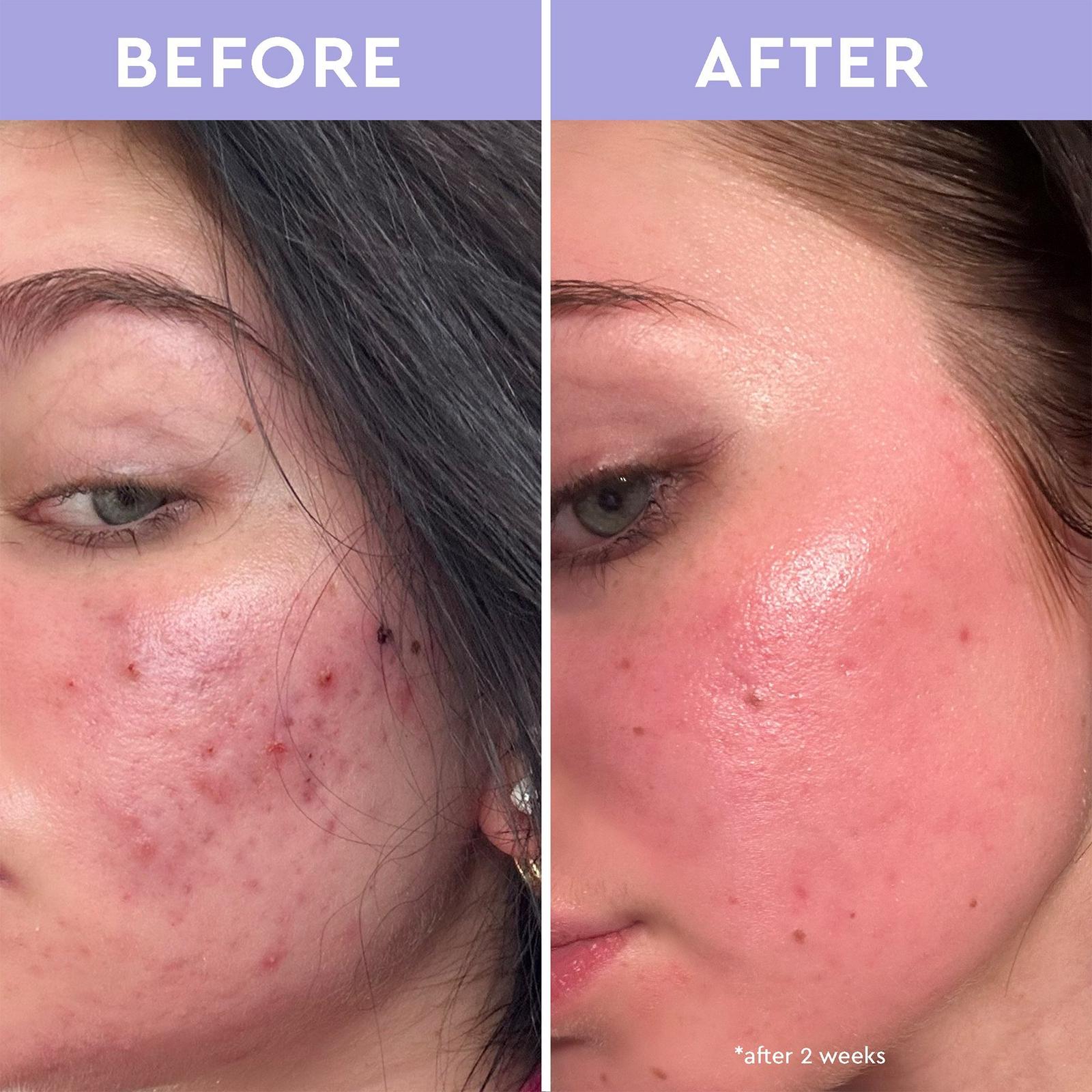 Spot A Spot Exfoliating Acne Solution
