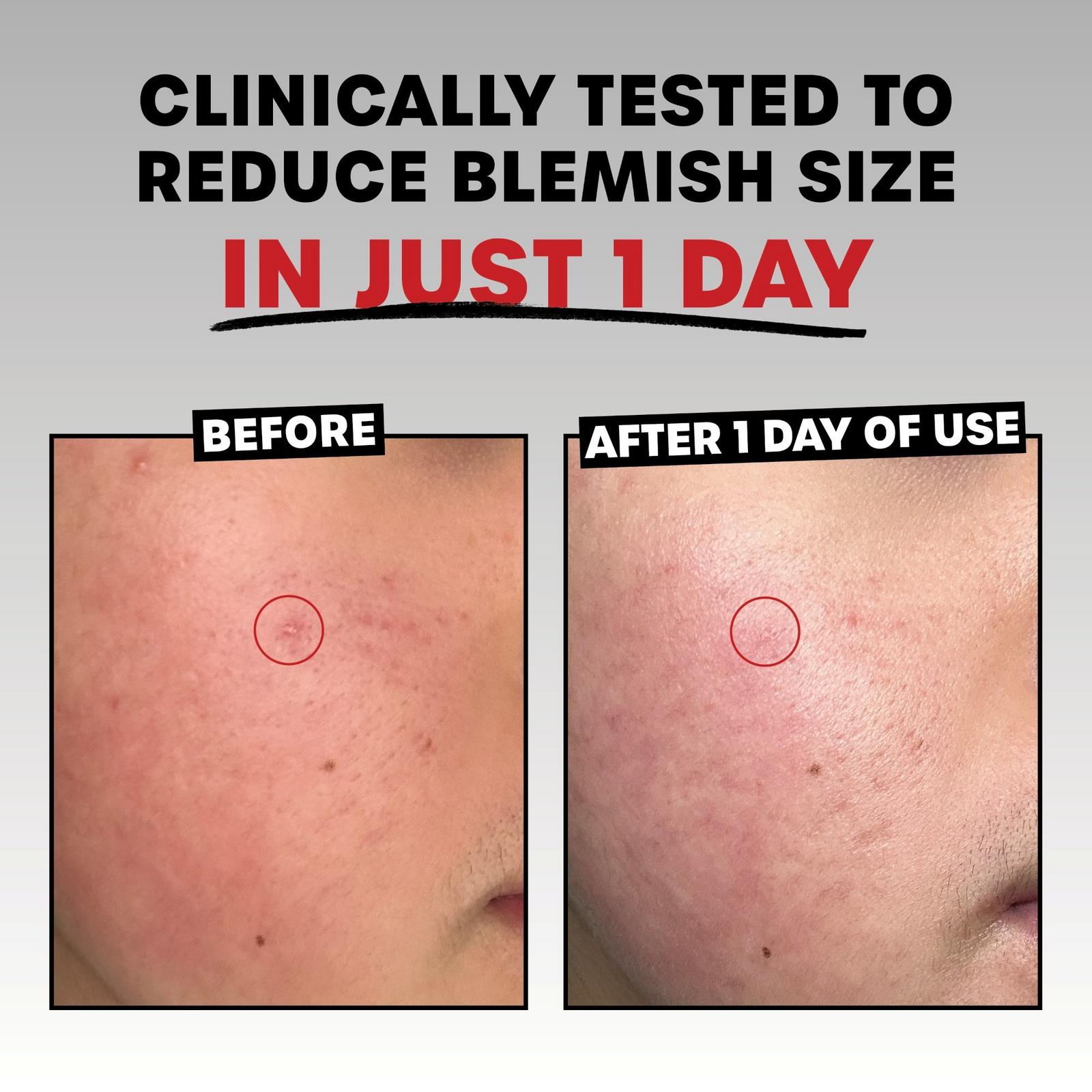 Rapid Acne Spot Treatment with Niacinamide and 10% Sulfur