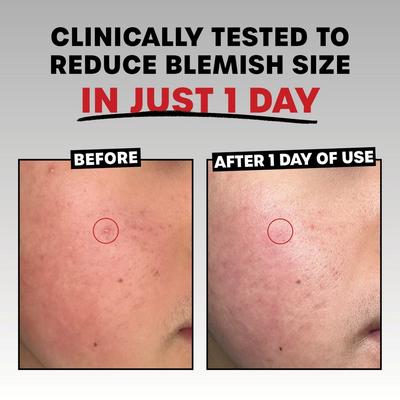 Rapid Acne Spot Treatment with Niacinamide and 10% Sulfur