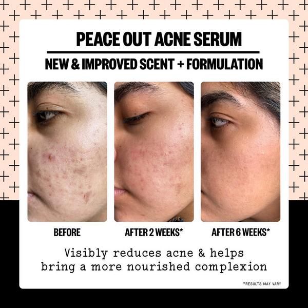 Peace Out Salicylic Acid Acne Treatment Serum #3