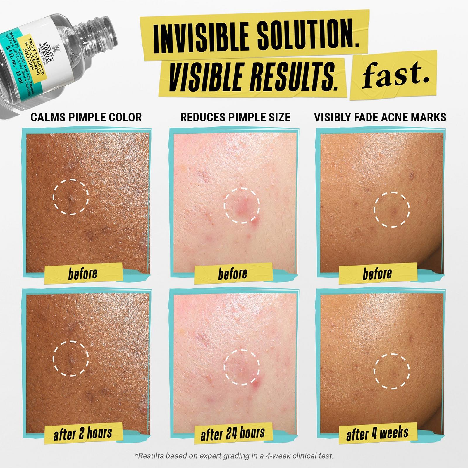 Truly Targeted Acne-Clearing Solution with Salicylic Acid