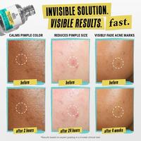Truly Targeted Acne-Clearing Solution with Salicylic Acid