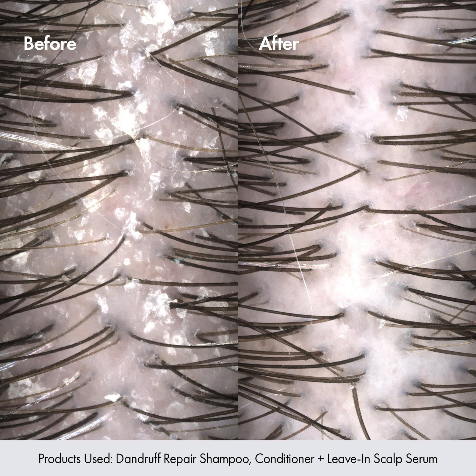 Dandruff Repair Leave-In Scalp Serum