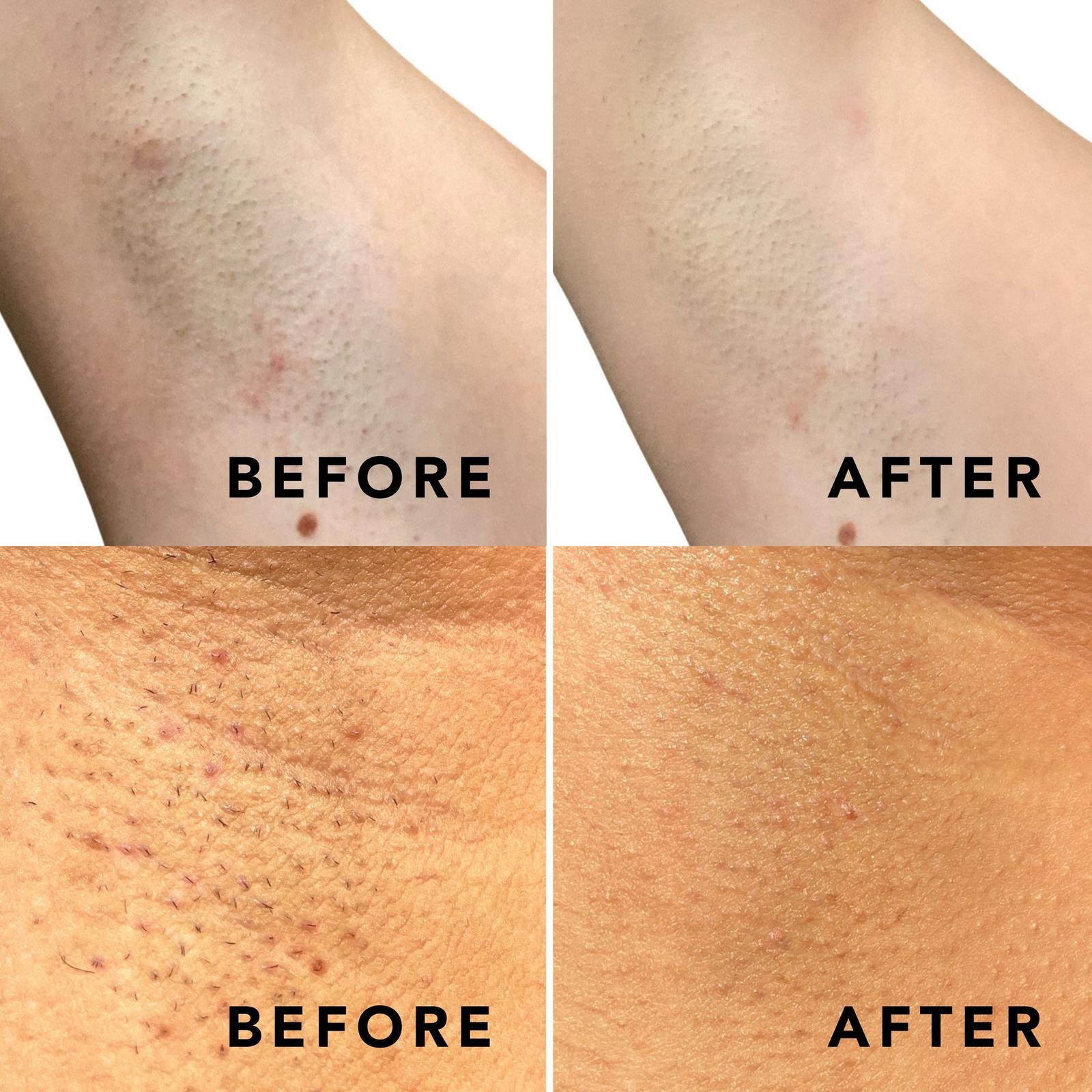 Buff & Brighten Ingrown Hair Treatment Spray