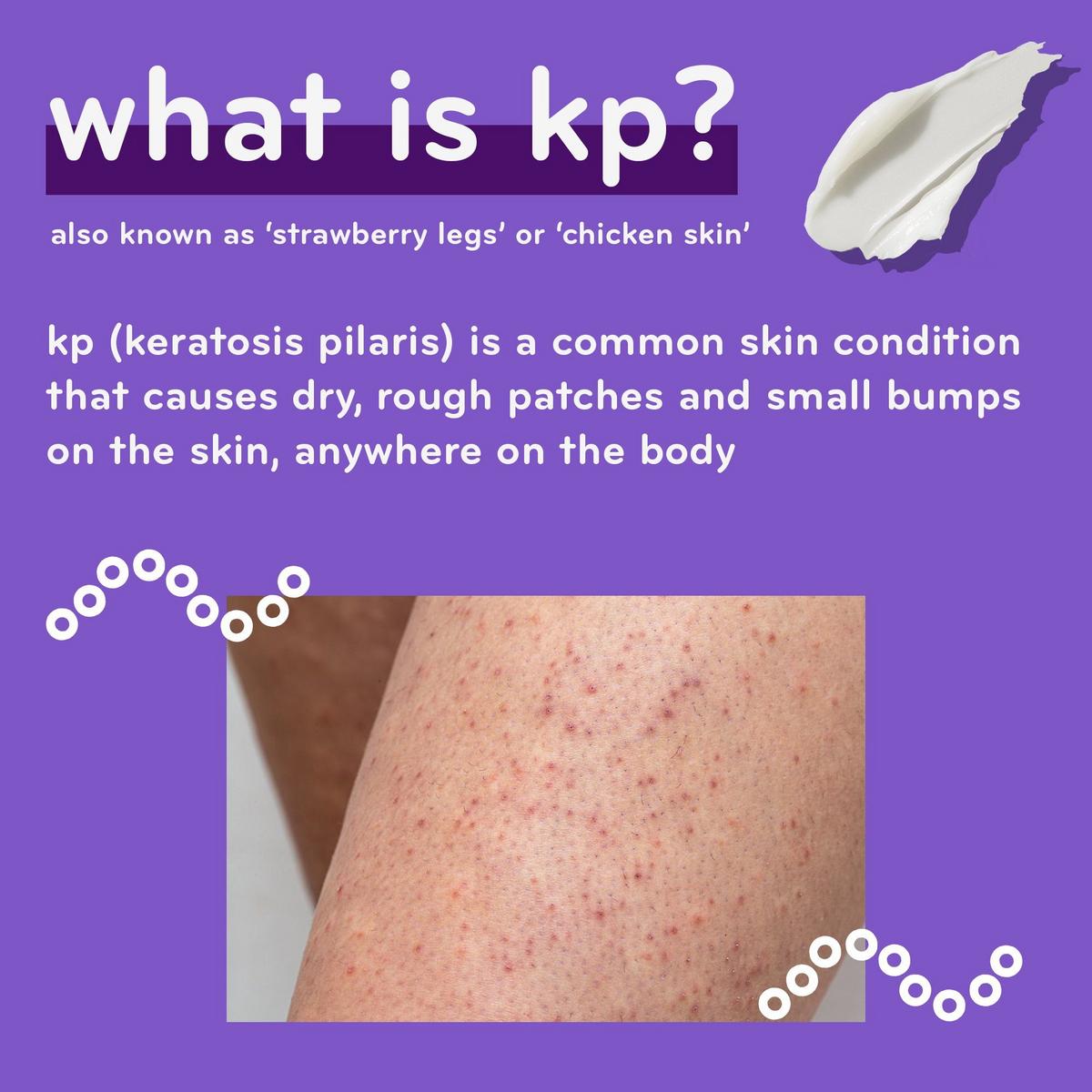 Keratosis pilaris ammonium lactate hotsell