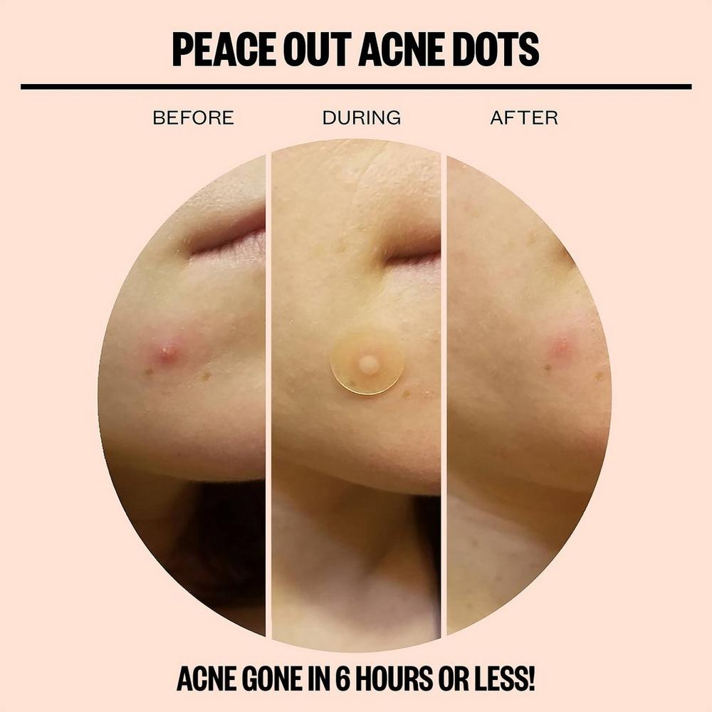 Travel Size Salicylic Acid Acne Healing Dots