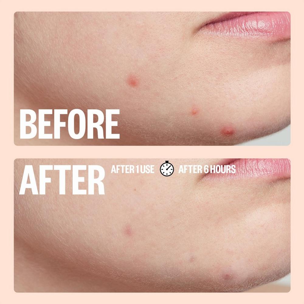 Travel Size Salicylic Acid Acne Healing Dots