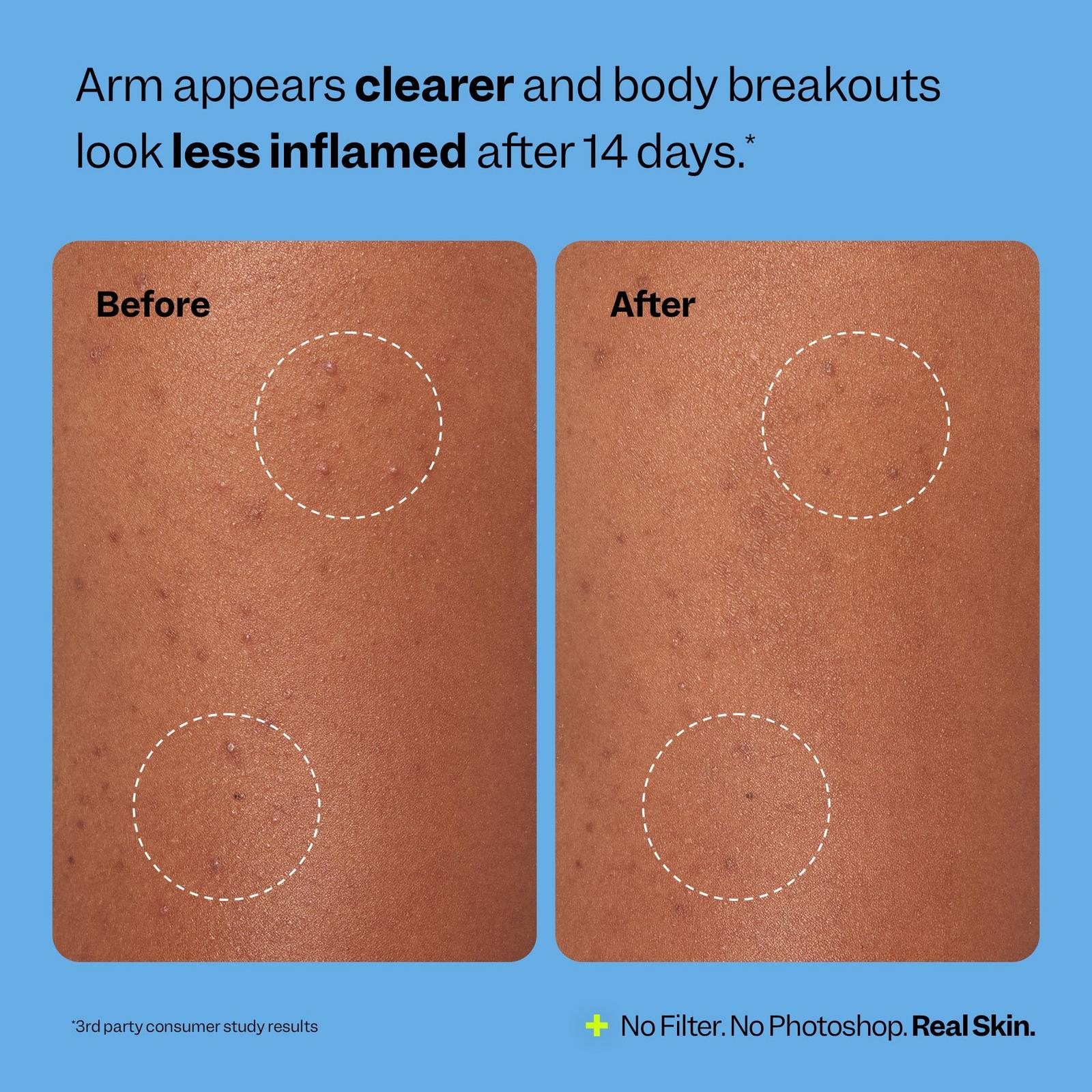 Body Breakout Patches