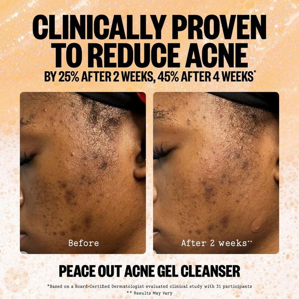 Peace Out 2% Salicylic Acid Acne Gel Cleanser #2