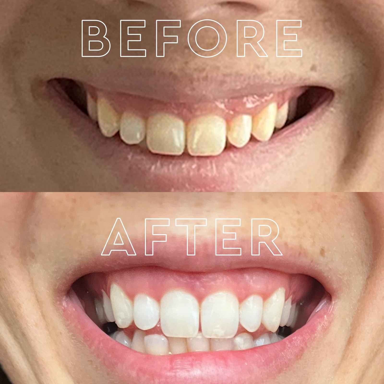 Platinum Pro Glow Teeth Whitening Device