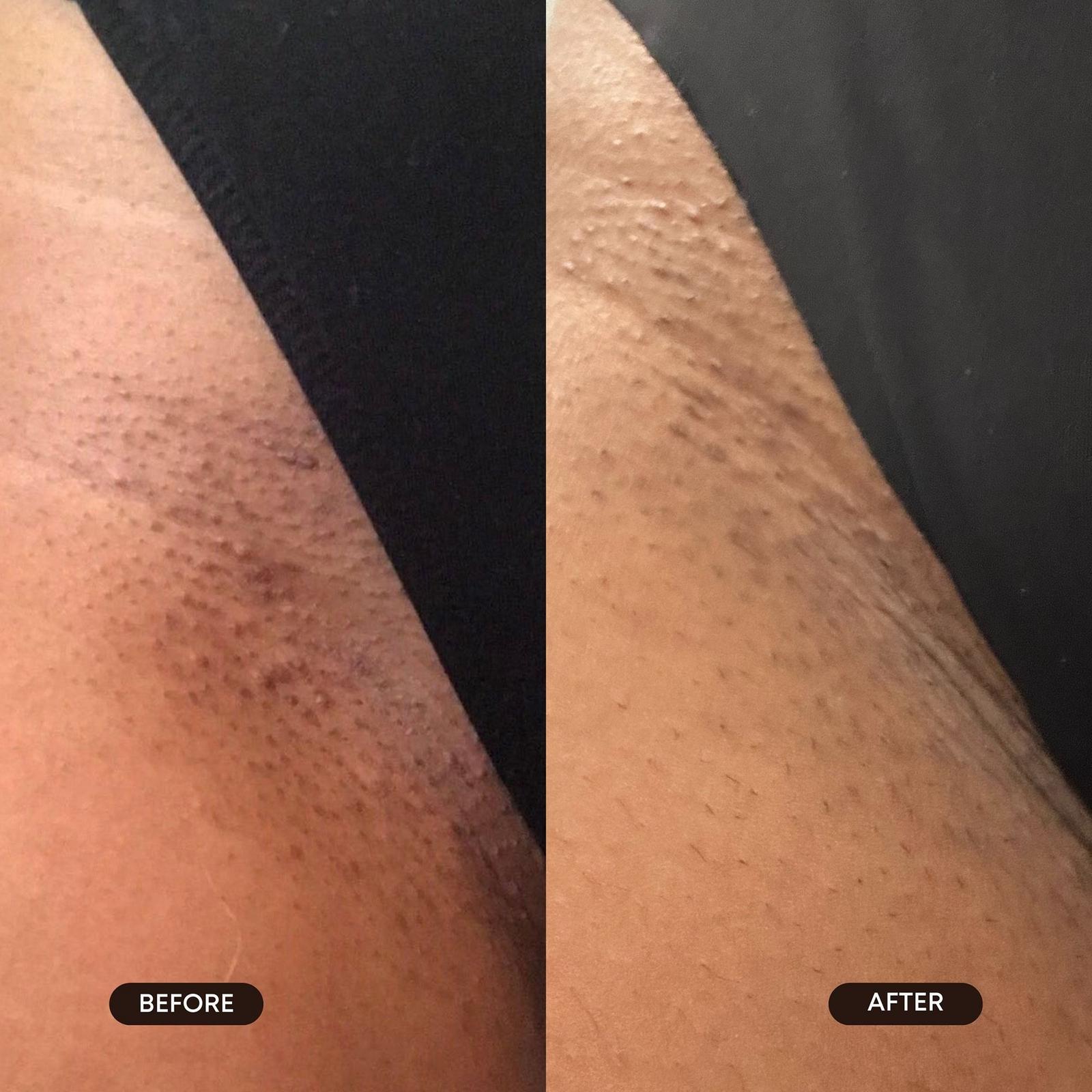 Radiant Reset Toner Pads for Dark Spots & Ingrown Hairs