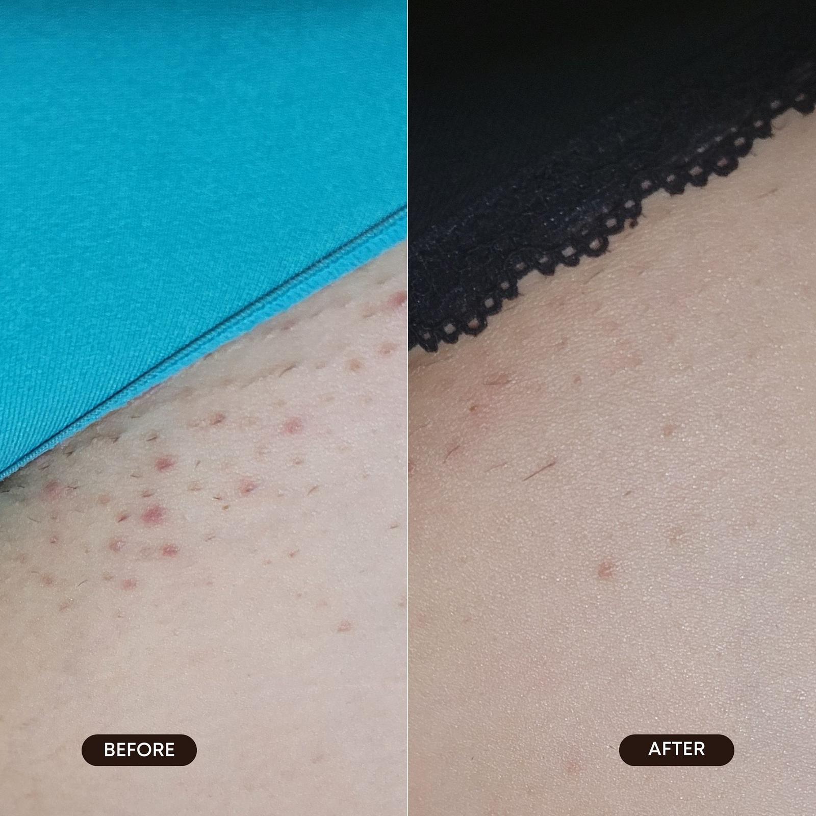 Radiant Reset Toner Pads for Dark Spots & Ingrown Hairs