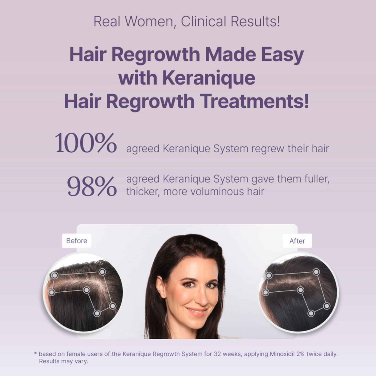 Hair Regrowth 5% Minoxidil Foam for Women 60-Day Supply