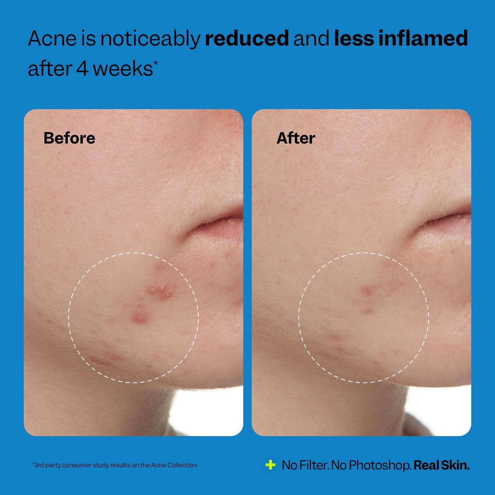 3-Step Acne Starter Kit
