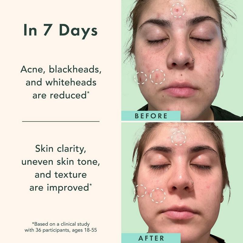 Rael - Miracle Clear Complete Acne Serum | Ulta Beauty