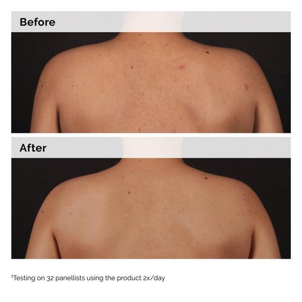 The Ordinary Salicylic Acid 0.5% Body Serum Exfoliating Treatment for Acne Blemishes #8