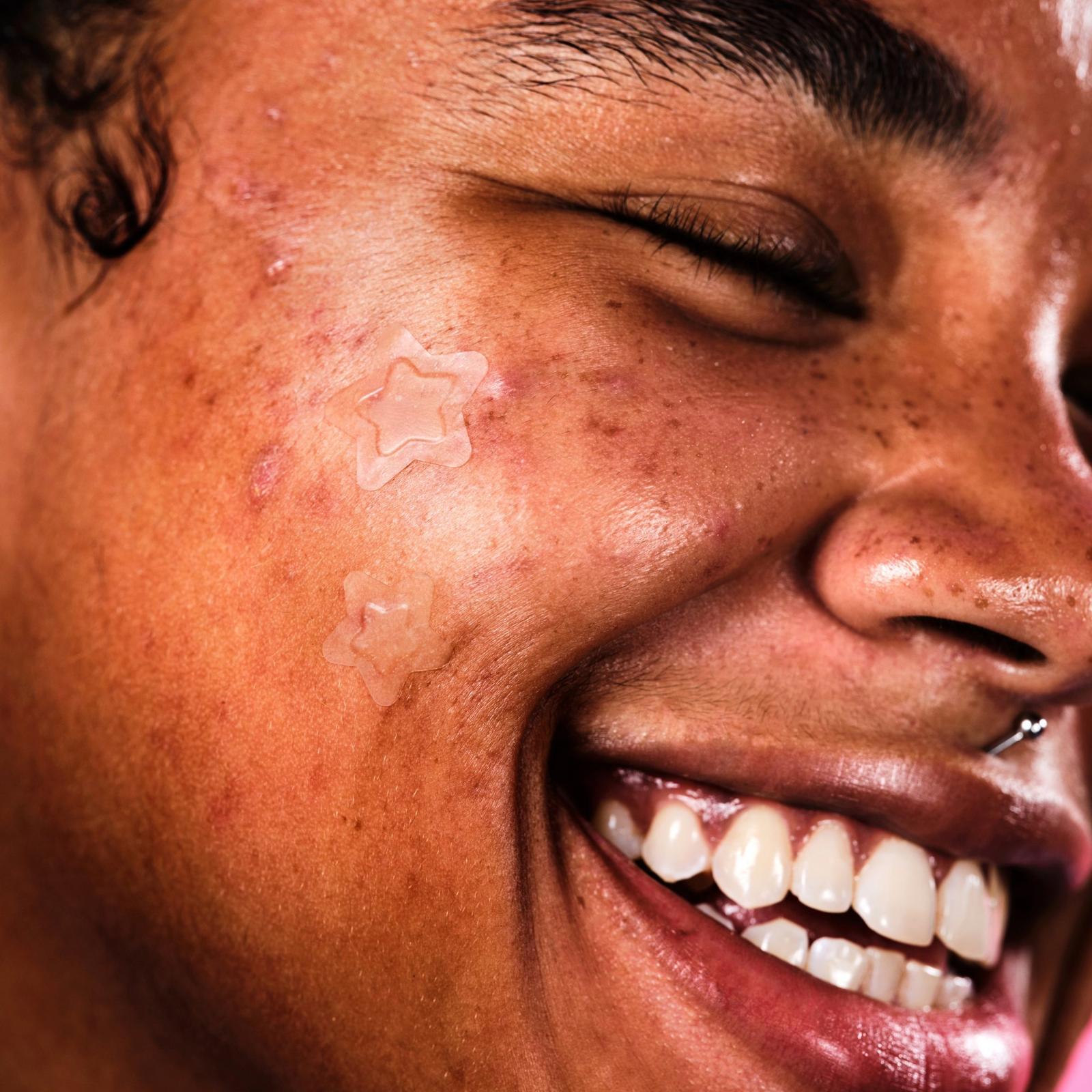 Hydro-Star Clear Pimple Patches