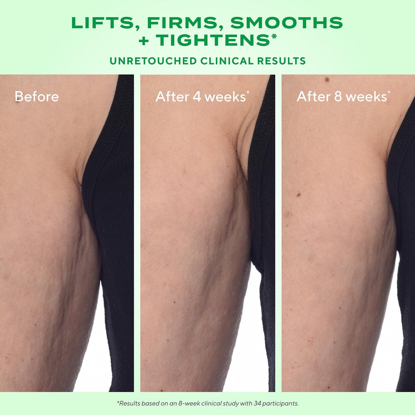 Retinal ReSculpt Body Lift Treatment