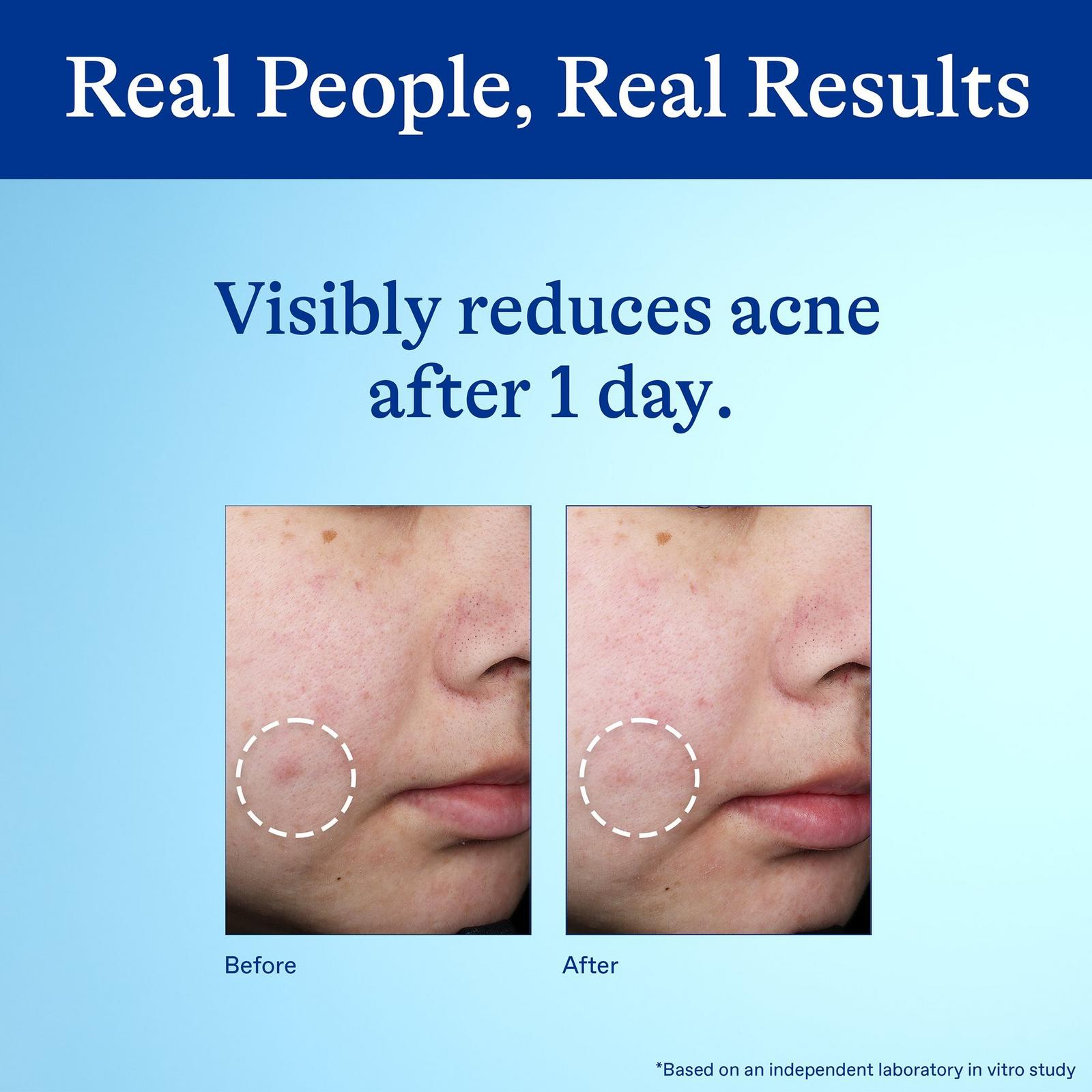 10% Benzoyl Peroxide Spot Treatment