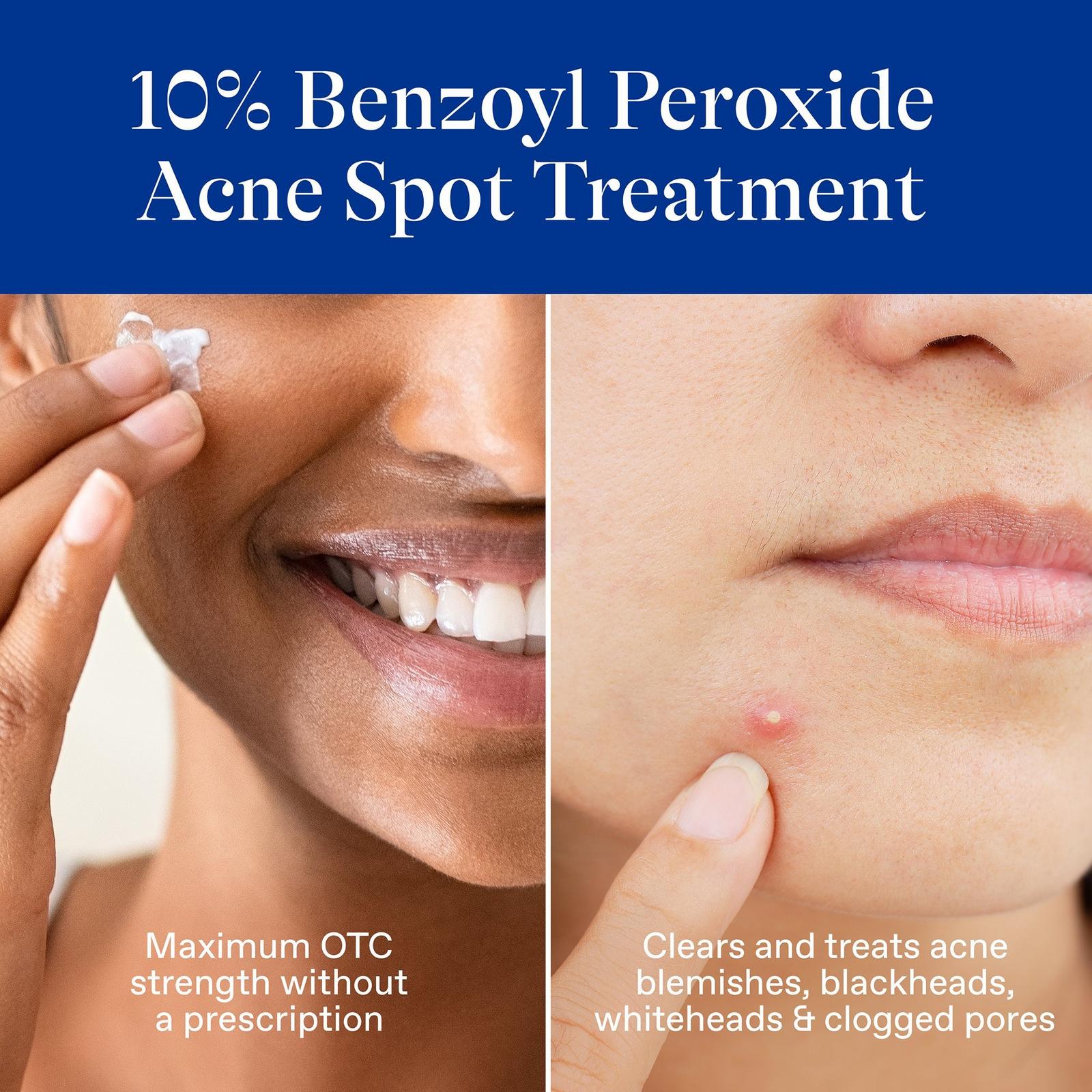 10% Benzoyl Peroxide Spot Treatment