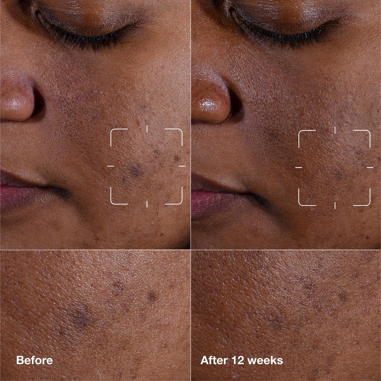 Even Better Clinical Dark Spot Clearing Serum with Vitamin C - 2.5 oz