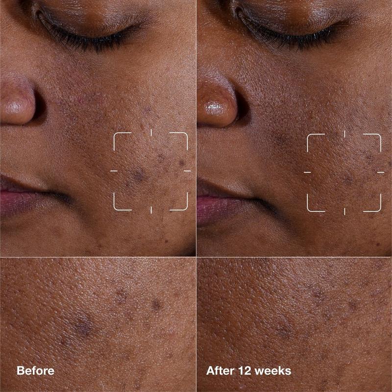 Clinique - 1.0 oz Even Better Clinical Dark Spot Clearing Serum