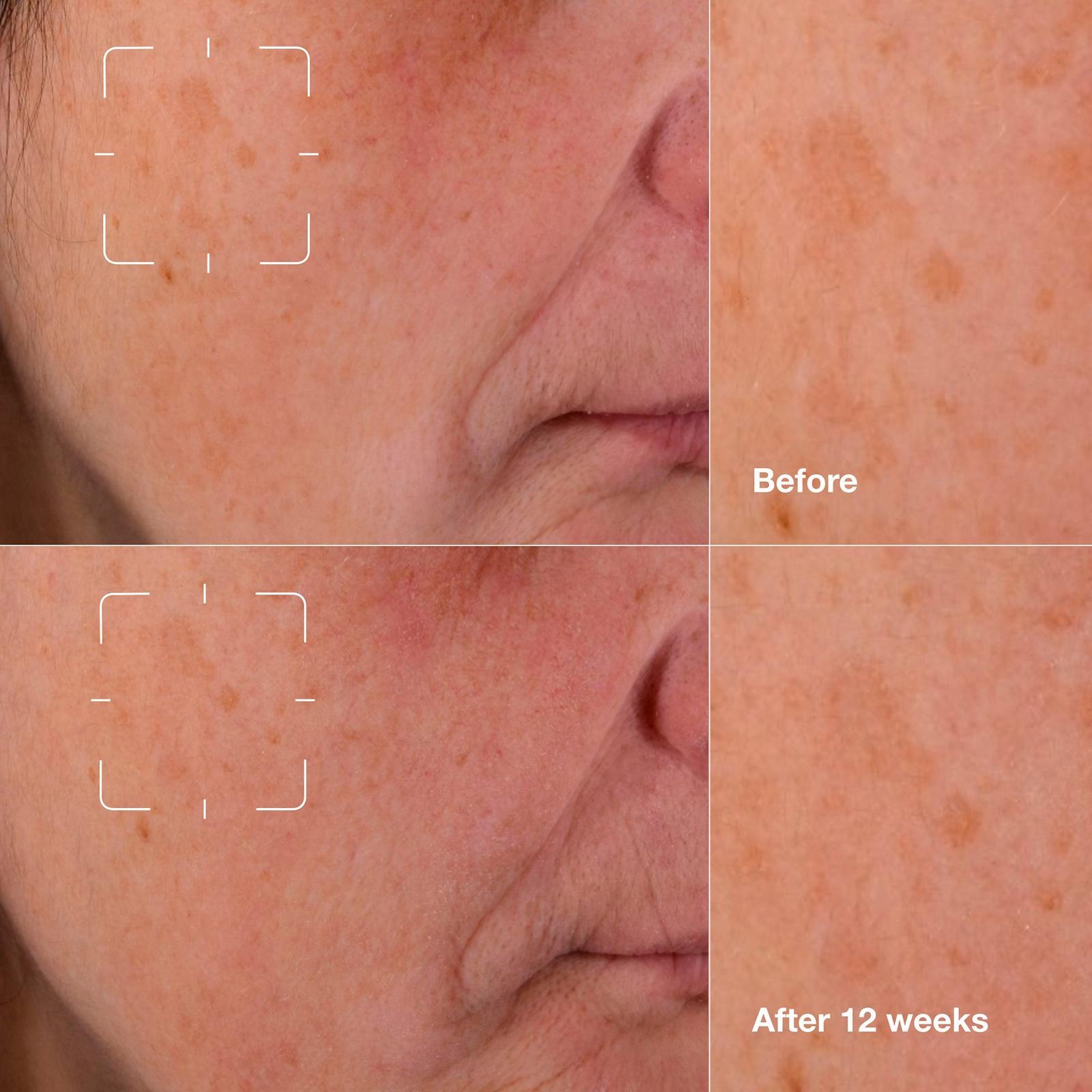 Even Better Clinical Dark Spot Clearing Serum with Vitamin C - 2.5 oz