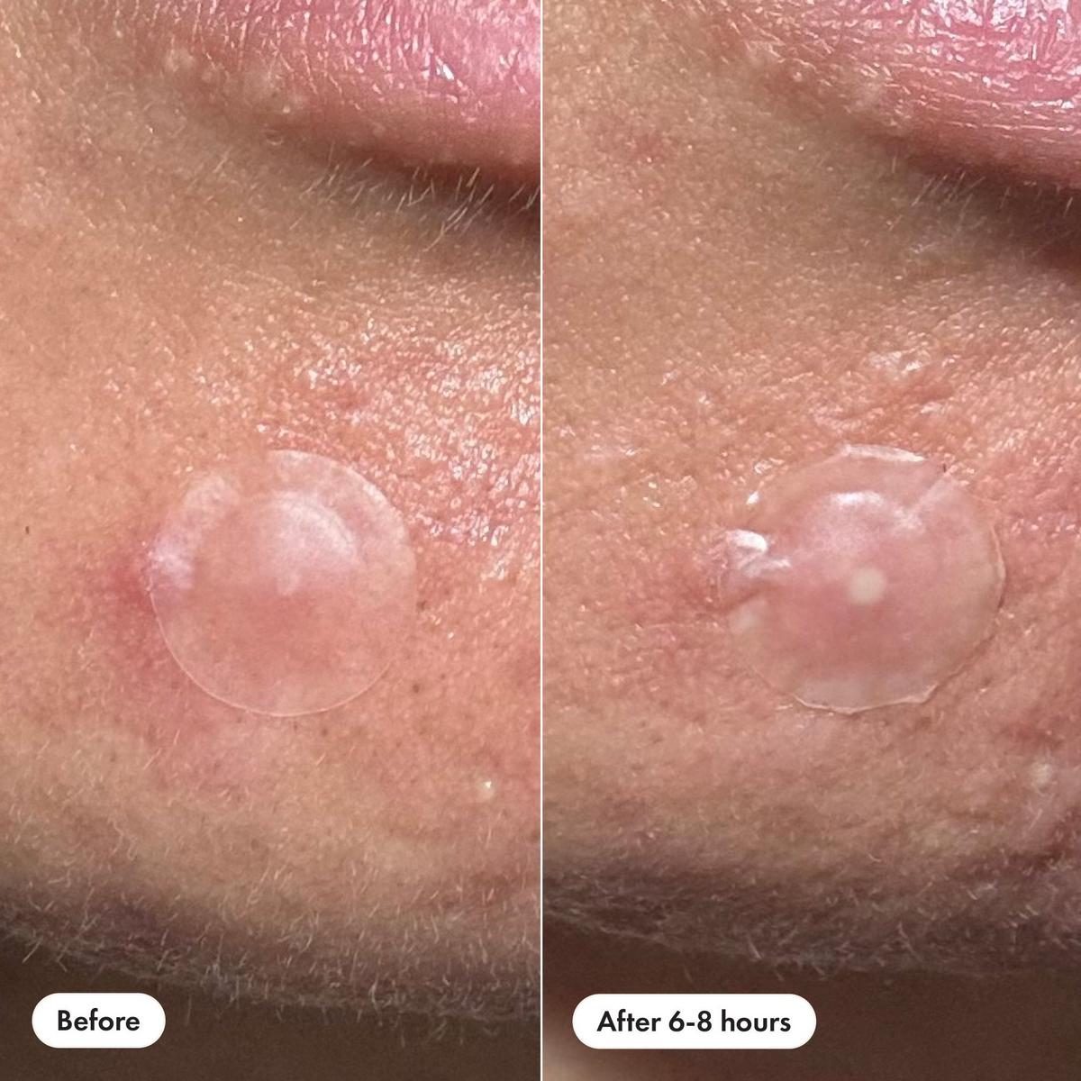 Mighty Patch Invisible+ Daytime Hydrocolloid Acne Pimple Patches - 72 ct