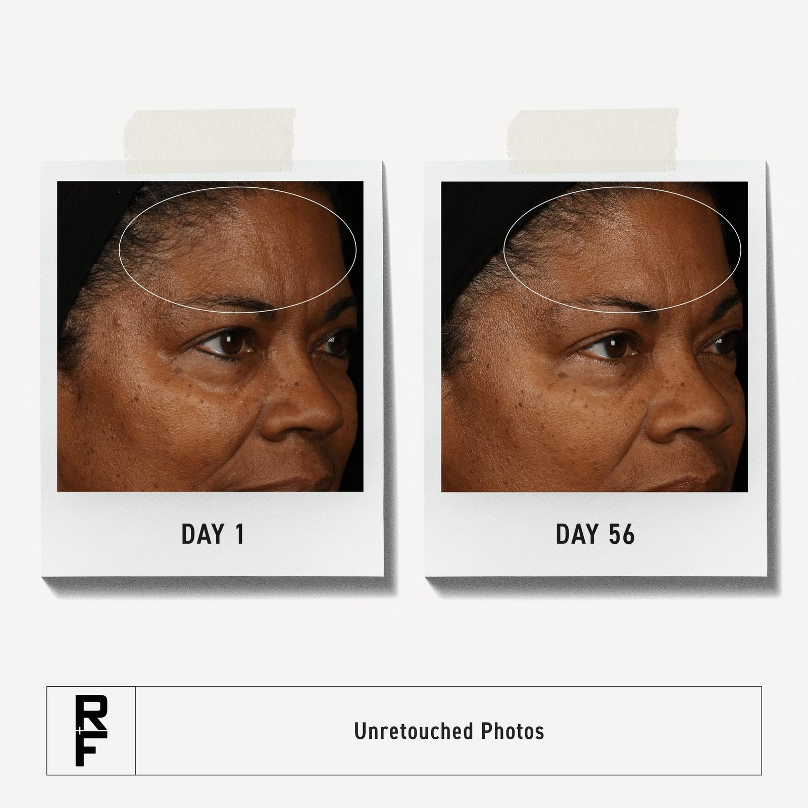 Redefine 30-Day Regimen for Fine Lines and Wrinkles