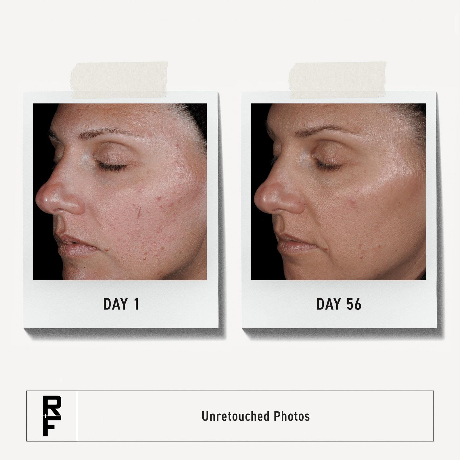 Unblemish 30-Day Regimen for Adult Acne