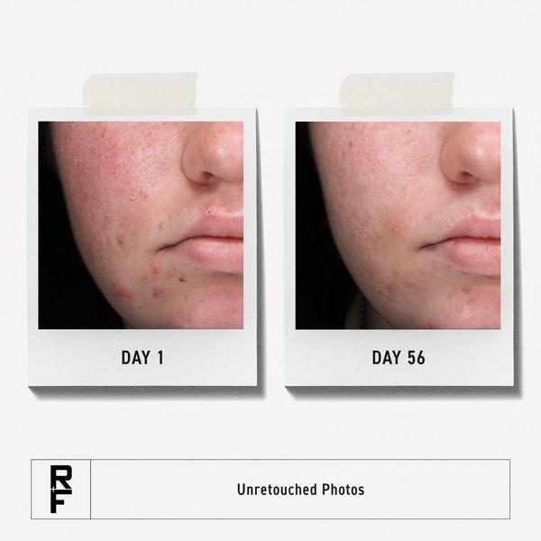 RODAN + FIELDS Spotless 30-Day Regimen for Teen Acne #5