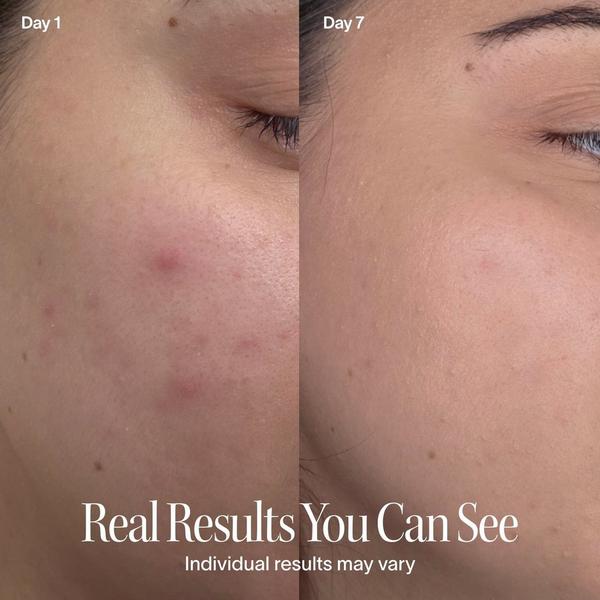 Solawave Bye Acne: 3-Minute Blue + Red Light Therapy Acne Treatment #7